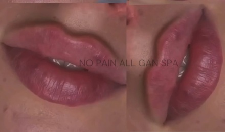 One Syringe of Juverderm Ultra XC for Lips Augmentation and Perioral Area (Smokers Lines) - No Pain All Gain Spa