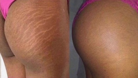 1 x 1 Inch scar camouflage  - Pompano Esthetics