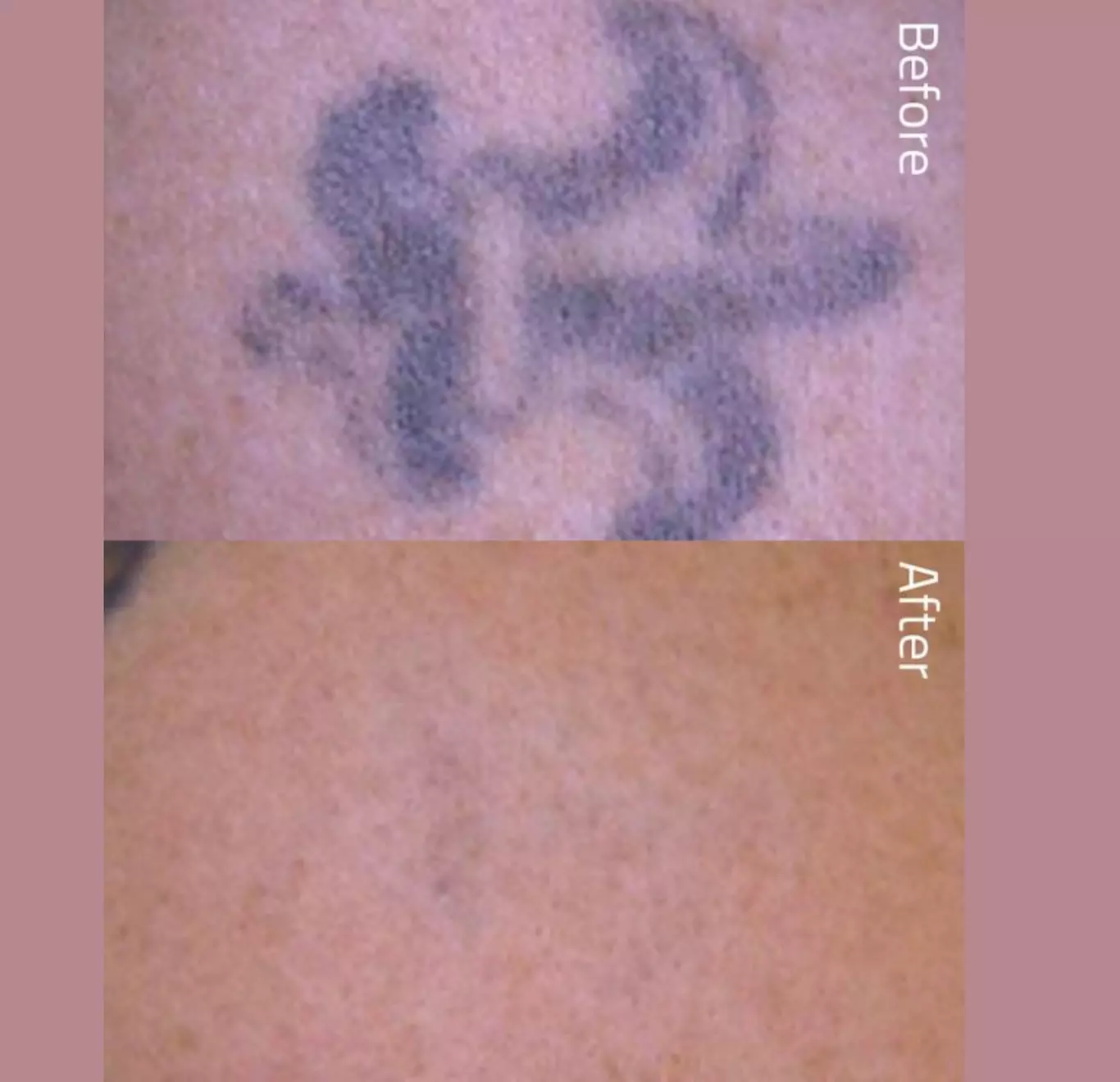 Enjoy One Laser Tattoo Removal Session on Small, Medium or Large Area at Aesthetics Care Med Spa (Up to 50% Off) - Primary Image