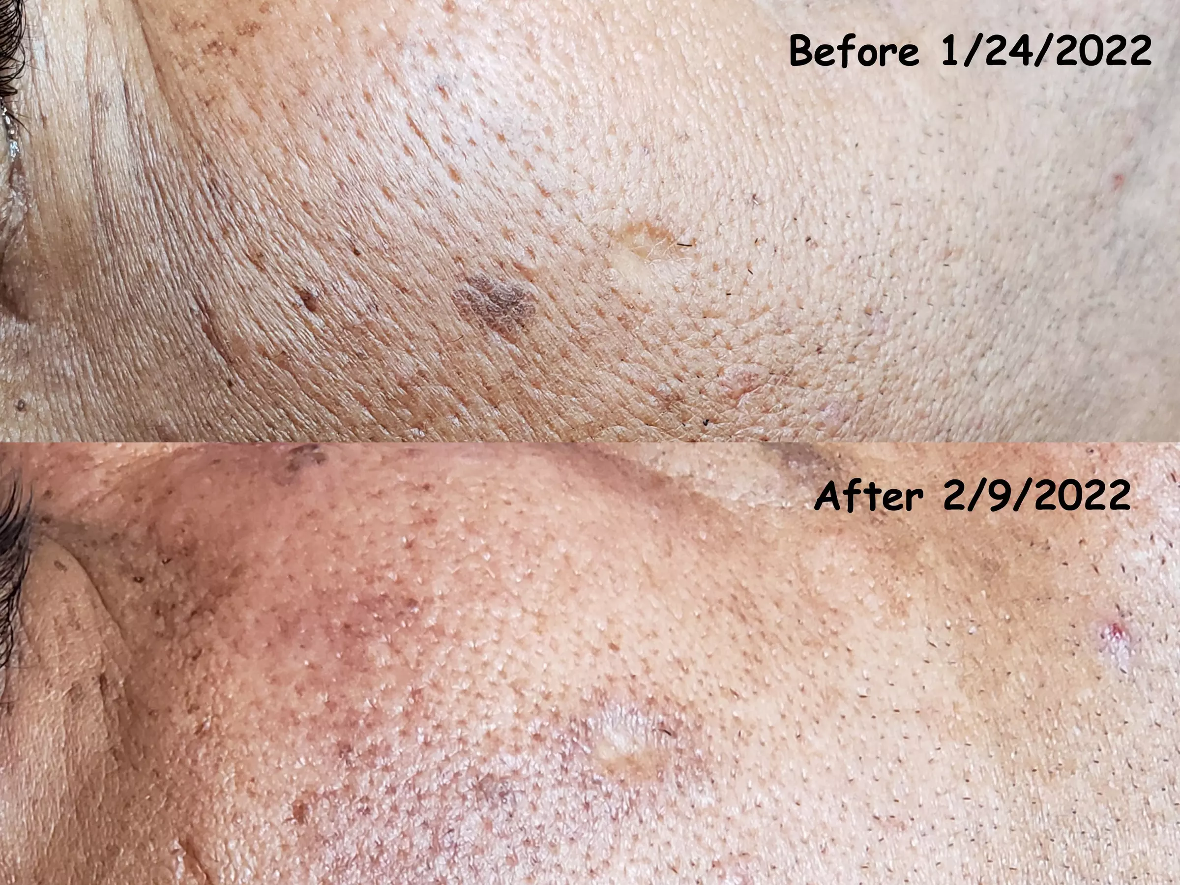 Up to 45% Off on Micro-Needling at HolliBalance Well-Being Center - Second Medium