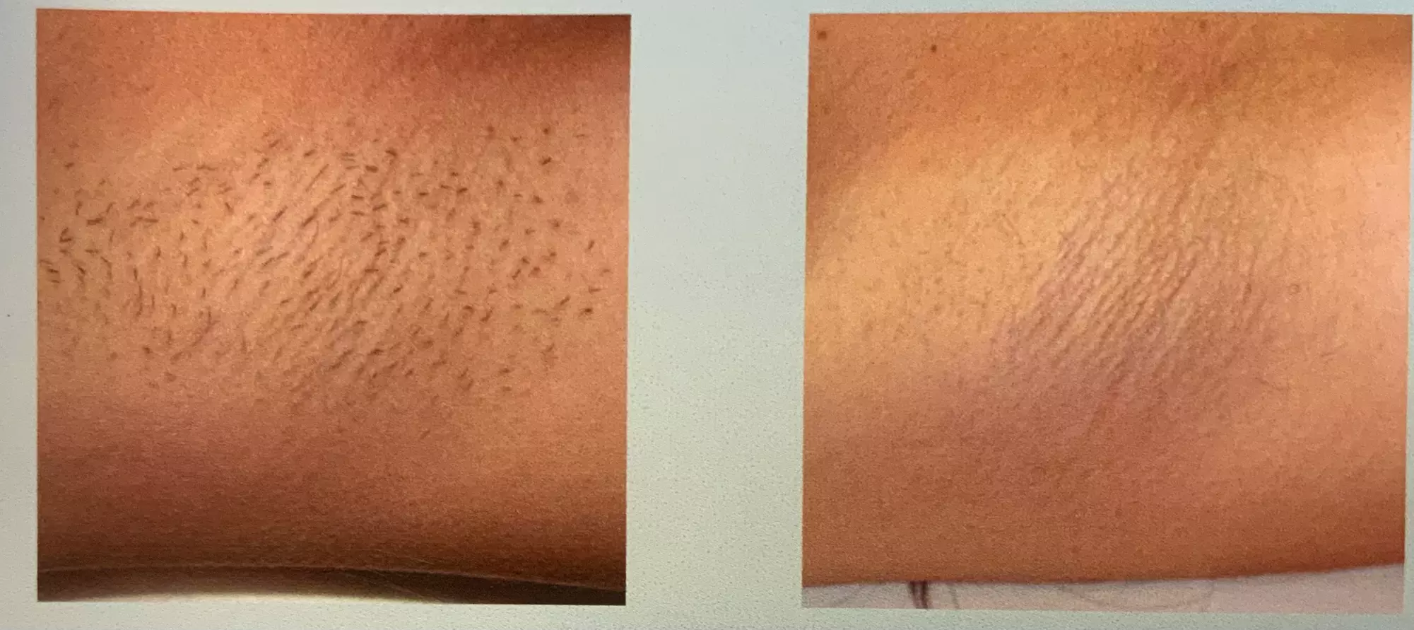 Up to 50% Off on Laser Hair Removal at Naked Lasers