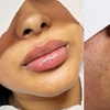 Image 1: Up to 61% Off on Injection - Dermal Filler at Skin Treat Aesthetics