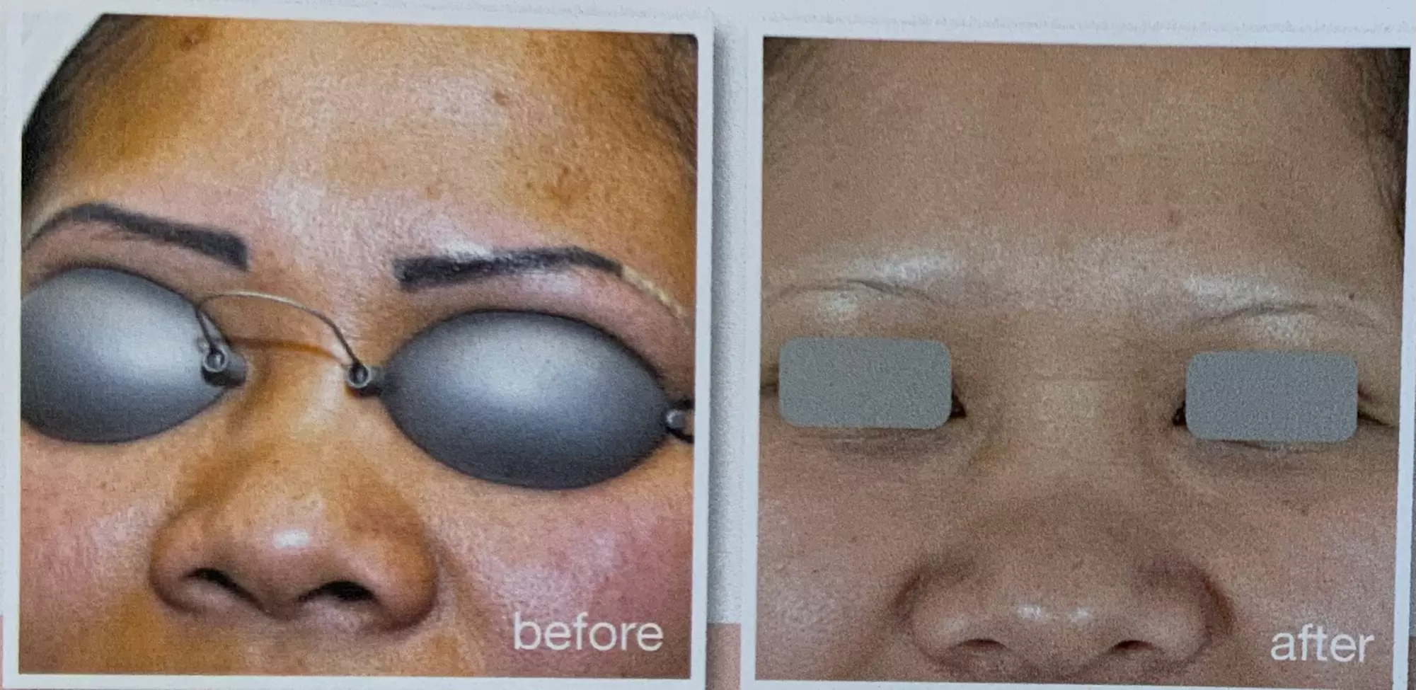 9-Session Laser Tattoo Removal for Areas Less than 1 in up to 88 Sq In