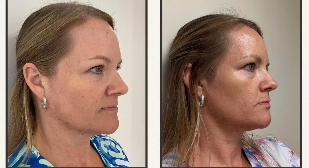 Up to 50% Off on Morpheus8 at Ziocorps Esthetique