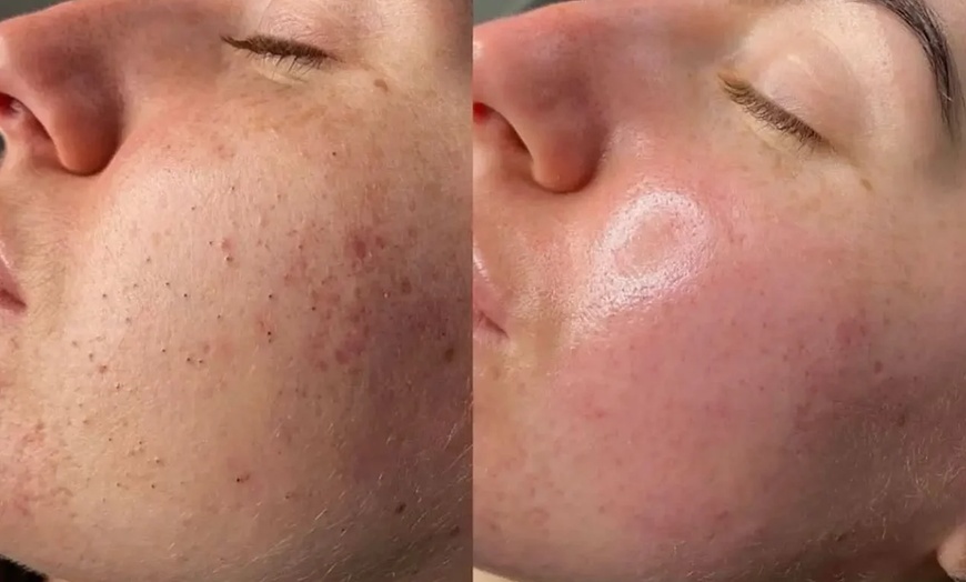 Image 2: One or Three Signature HydroFacial with LED Therapy Treatments