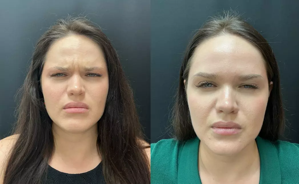 Smooth Away Lines with Botox Lip Flip, 20 or 40 Units of Botox