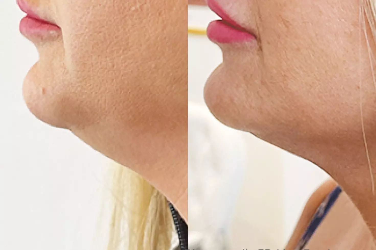 HiFu Treatments for Full Face and/or Neck with Jowls and Jawline