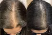 1, 2, or 3 Exosome Stem Cell or Advanced Hair Restoration Therapy with Thulium RF & Mesotherapy (Up to 40% Off) - Second Medium
