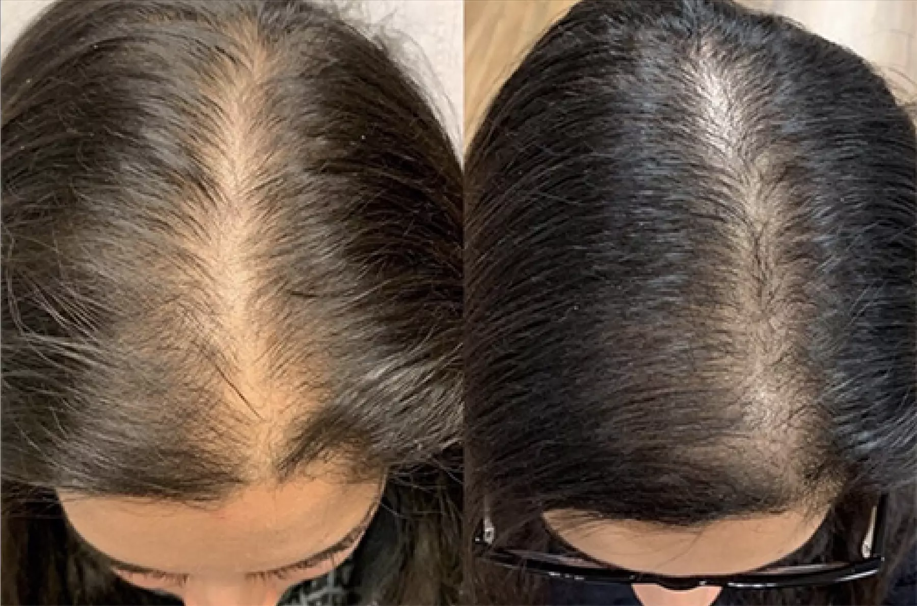 1, 2, or 3 Exosome Stem Cell or Hair Restoration w/ Thulium RF & More