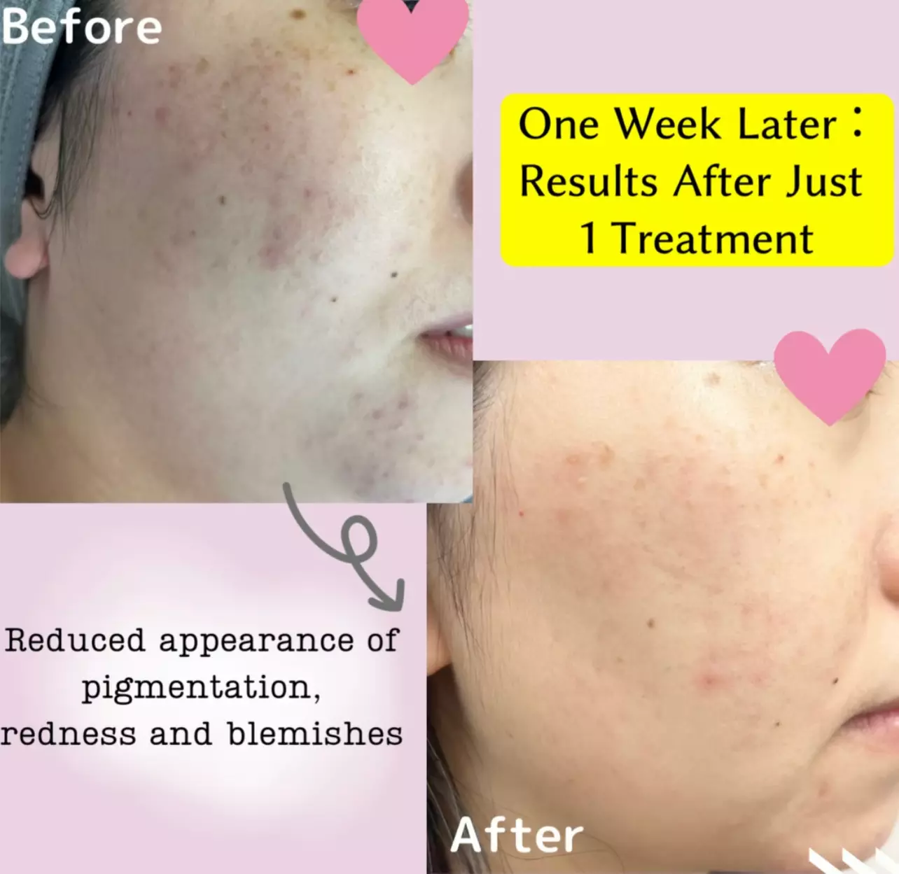 Up to 25% Off on Facial - Peeling at Pua Aina Hawaii - Primary Image