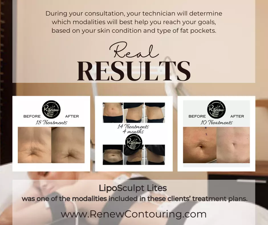 Choose from Two, Four, or Six Lipo Sculpt Lite Sessions