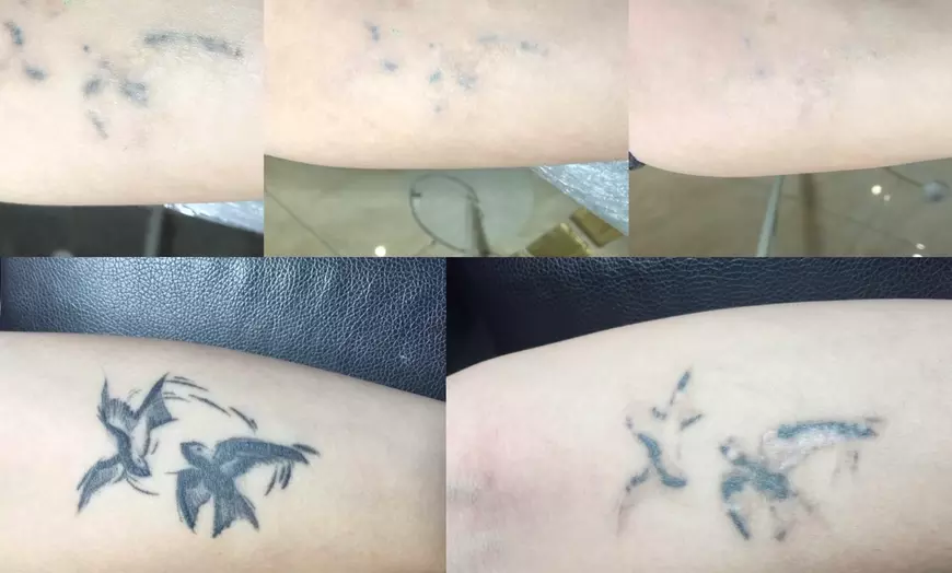 Image 2: Up to 64% Off on Pico Laser Tattoo Removal at Beaucontour
