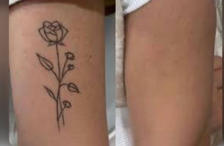 Laserowe usuwanie tatuażu: do 10 cm x 10 cm