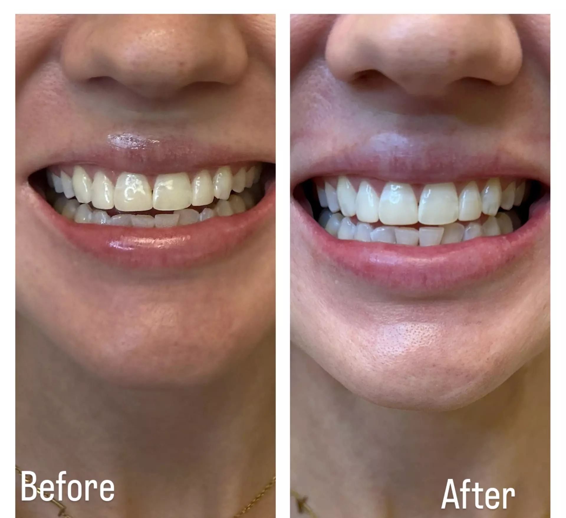 Brighten Your Smile w/ 1 or 2 Beaming White LED Teeth Whitening