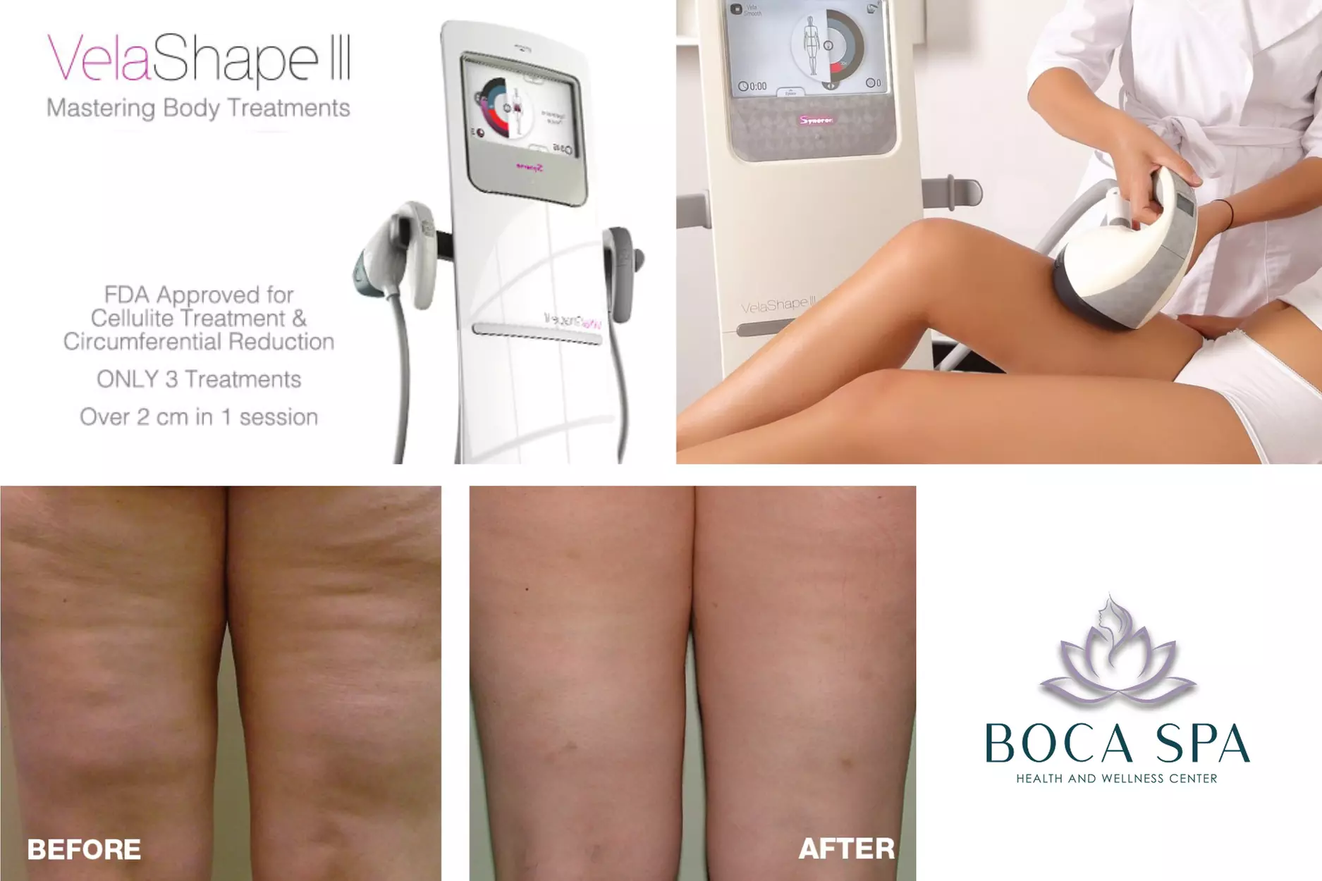 Three, Six or Nine Sessions of VelaShape