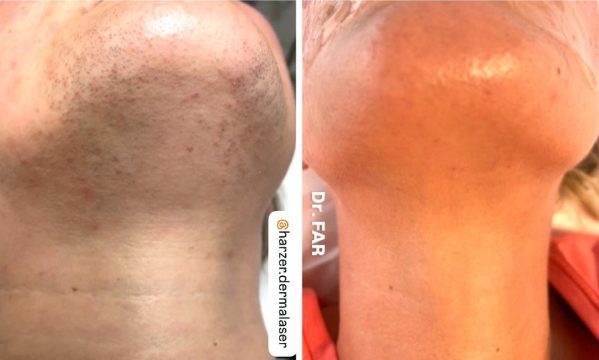 Image 5: 50-70 Min. Weihnachtsglow: HydraBoost-Gesichtsbehandlung für 1 Person