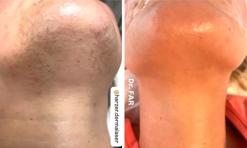 50-70 Min. Weihnachtsglow: HydraBoost-Gesichtsbehandlung für 1 Person