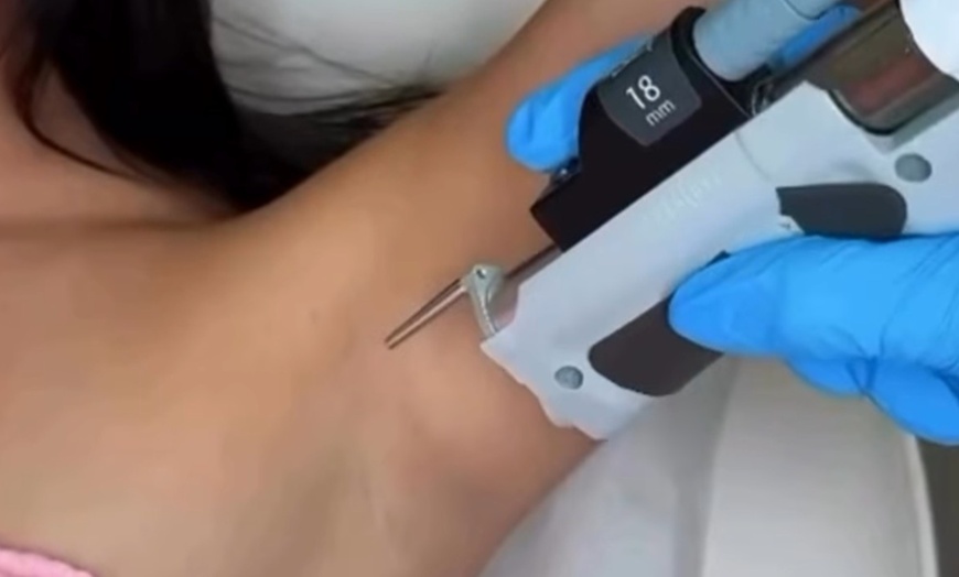 Image 4: Expert Laser Hair Removal for Small, Medium, or Large Areas