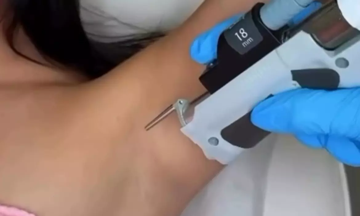 Expert Laser Hair Removal for Small, Medium, or Large Areas