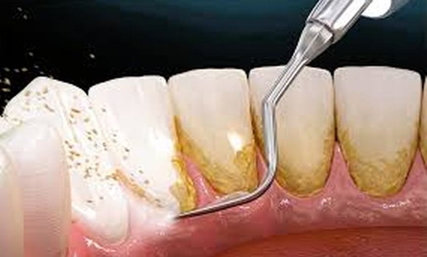 Image 2: Achieve Beautiful Smile w/ Professional Dental Care or Teeth Whitening