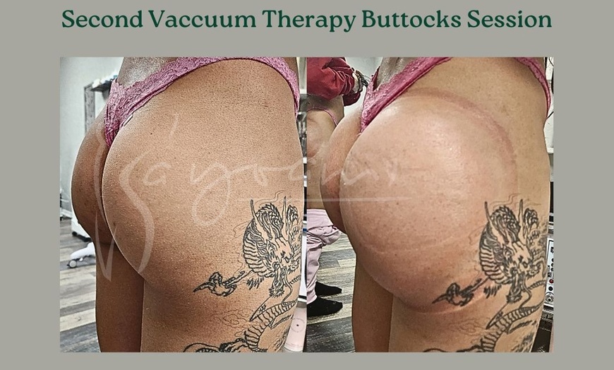 Image 5: Vacuum Therapy Buttocks & Body Enhancement or CryoStatic Slimming