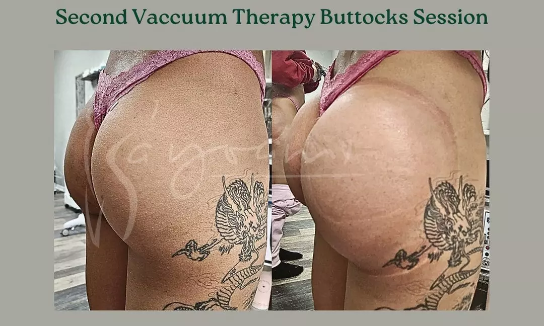 Vacuum Therapy Buttocks & Body Enhancement or CryoStatic Slimming