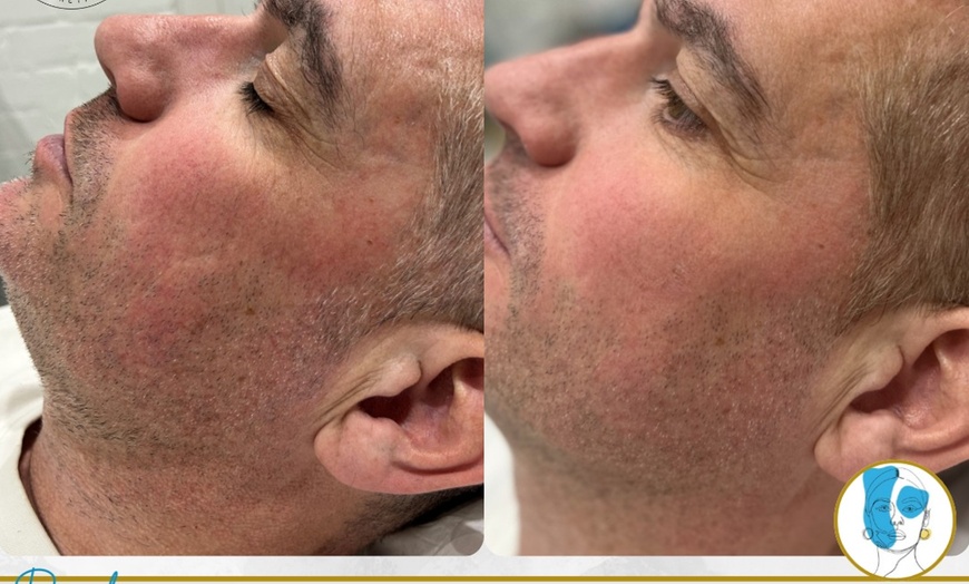 Image 1: Get Two, Four or Six Radio-Frequency Microneedling Treatment 