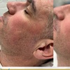 Image 1: Get Two, Four or Six Radio-Frequency Microneedling Treatment 