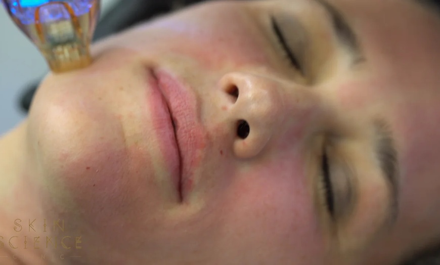 Image 3: Microneedling Facial with Optional PepFactor – 1 or 3 Treatments
