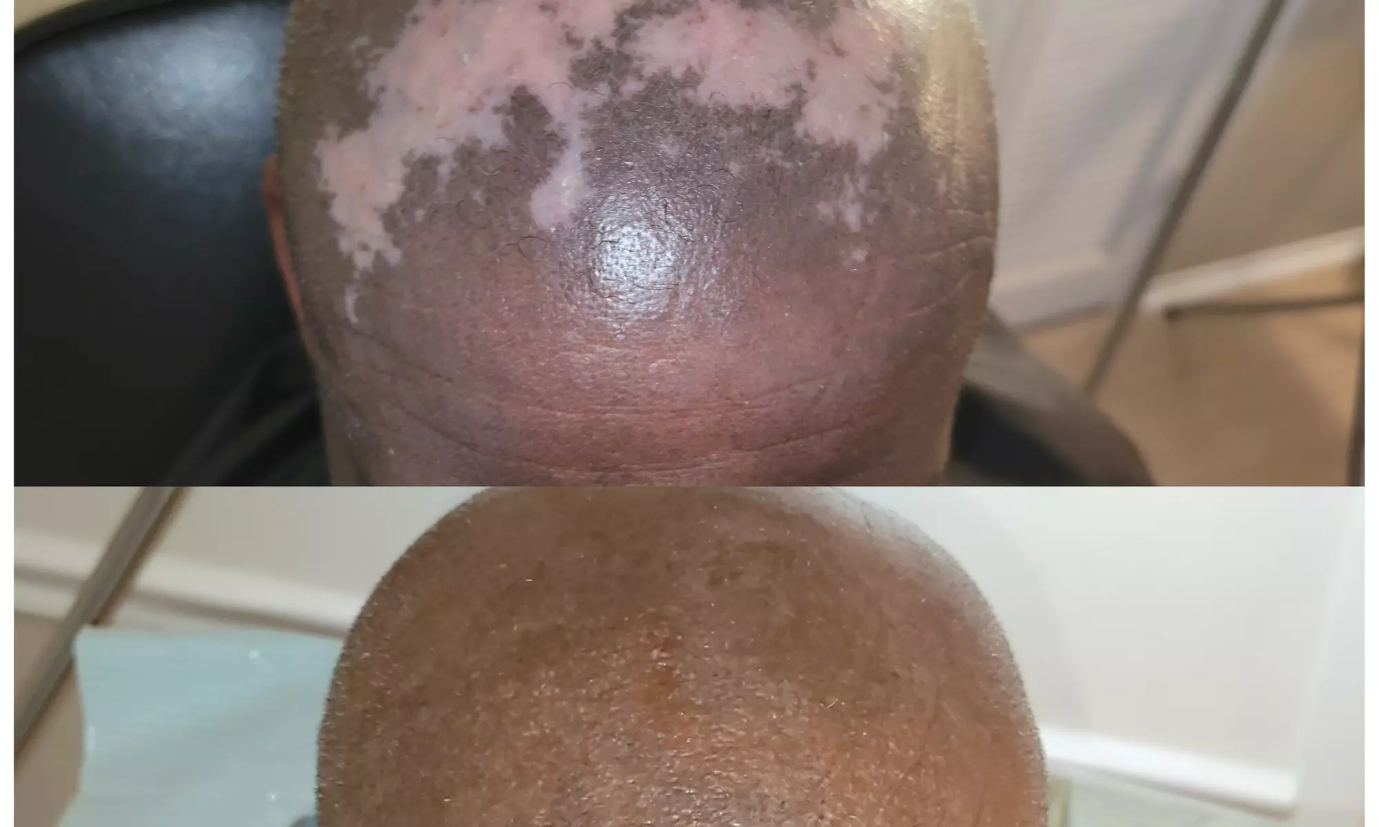 Up to 50% Off on Men and Women's Scalp Micropigmentation