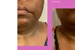 Get Total Body Sculpt, Peach Perfection, / Mommy Makeover Glow Package @ToptierBeautyBody spa (Up to 70% Off) - Second Medium