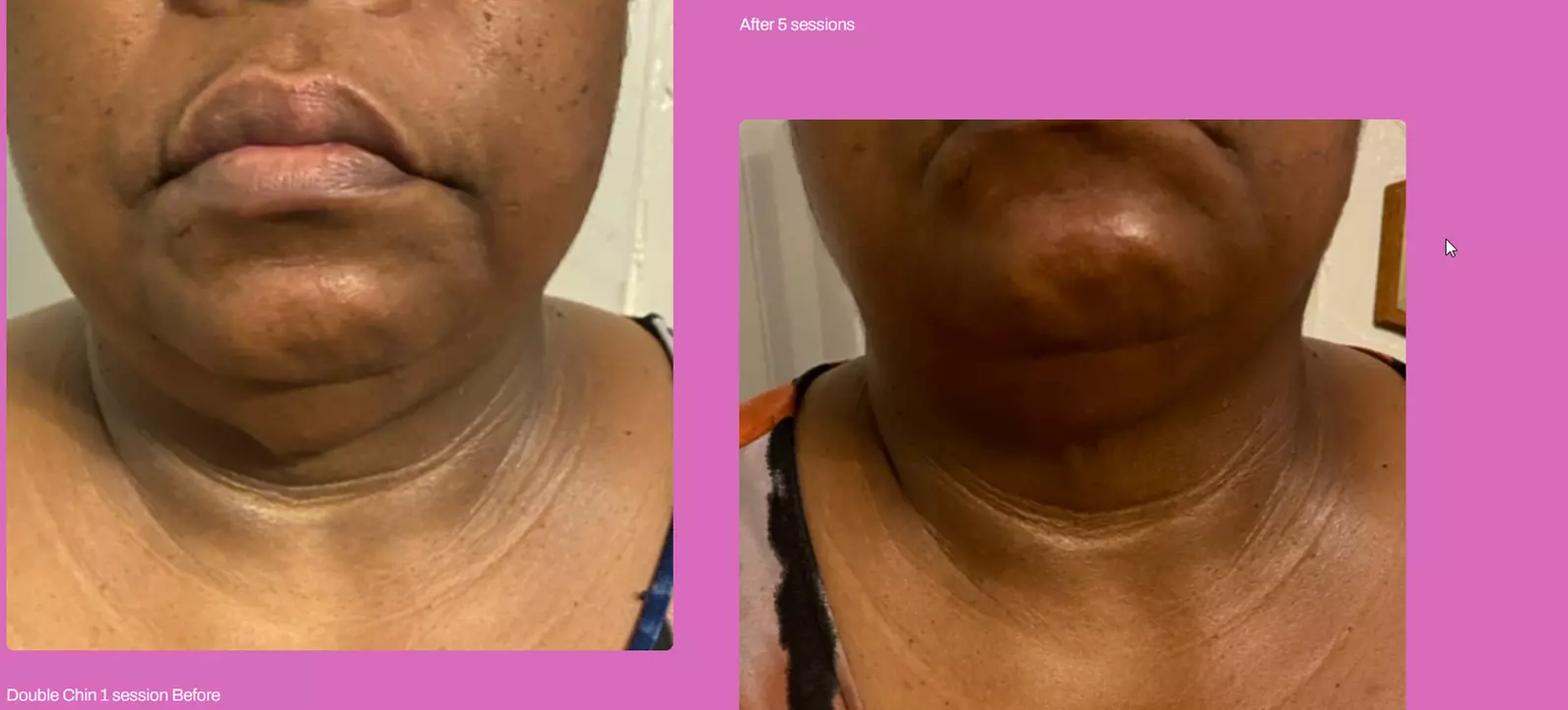Get Total Body Sculpt, Peach Perfection, / Mommy Makeover Glow Package