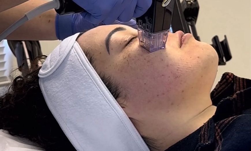 Image 5: Revitalize Your Face with RF Micro-Needling Session!