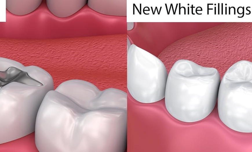 Image 1: Get a One Dental Exam, X-ray w/t Tooth cosmetic White Filling & More