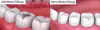 Explore Your One Dental Exam, X-ray w/t Tooth cosmetic White Filling & More - Up to 73% Off