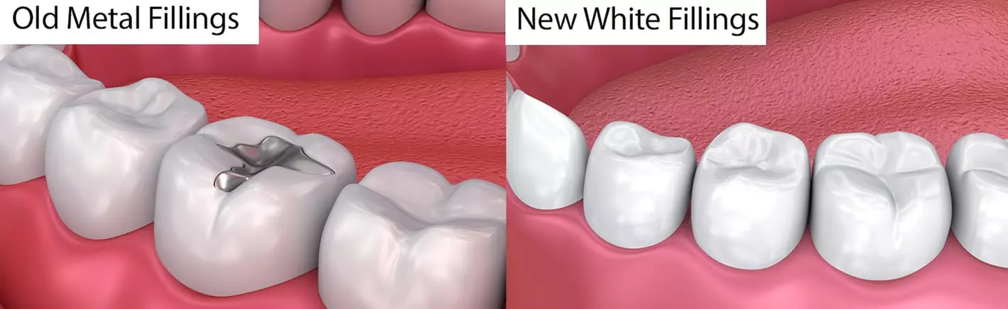 Get a One Dental Exam, X-ray w/t Tooth cosmetic White Filling & More