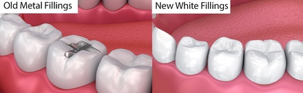 Dental Exam, 1 X-ray, General Cleaning & 1 cosmetic White Filling - Your Covina Family Dentistry