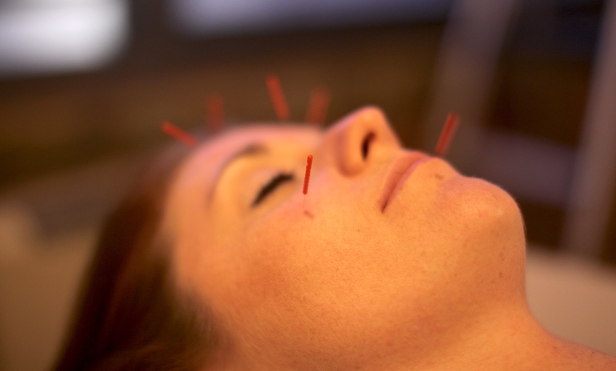 Image 2: Get Acupuncture Facial Rejuvenation