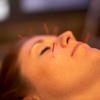Image 2: Get Acupuncture Facial Rejuvenation