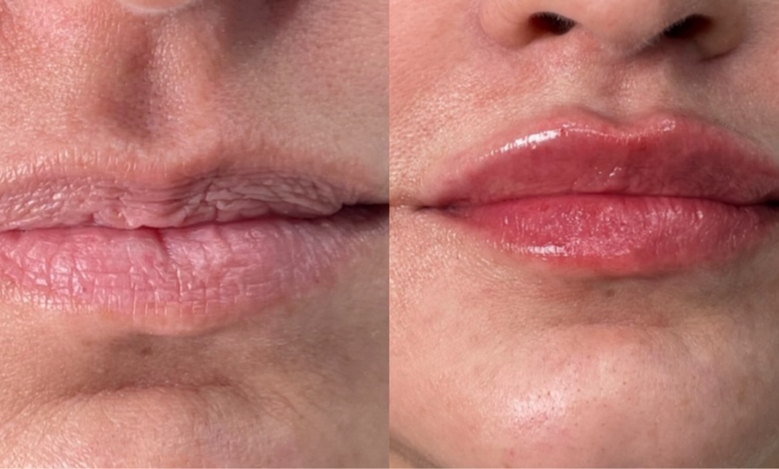 Image 2: Half Or One Full Syringe of Revanesse Versa for Lip Enhancements