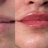 Image 2: Half Or One Full Syringe of Revanesse Versa for Lip Enhancements