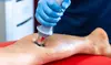 Restore Mobility w/ 2 or 3 Shockwave Therapy or Extracorporeal Shockwave @Back To You Rehab PLLC (Up to 55%Off)