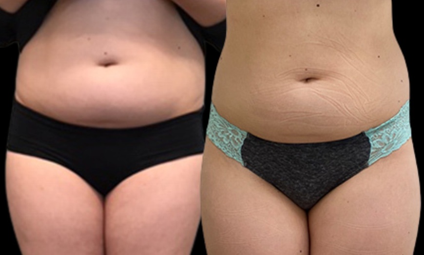 Image 2: Up to 79% Off on Lipo - Non-Invasive Laser-iLipo at Atlanta Body Sculpt