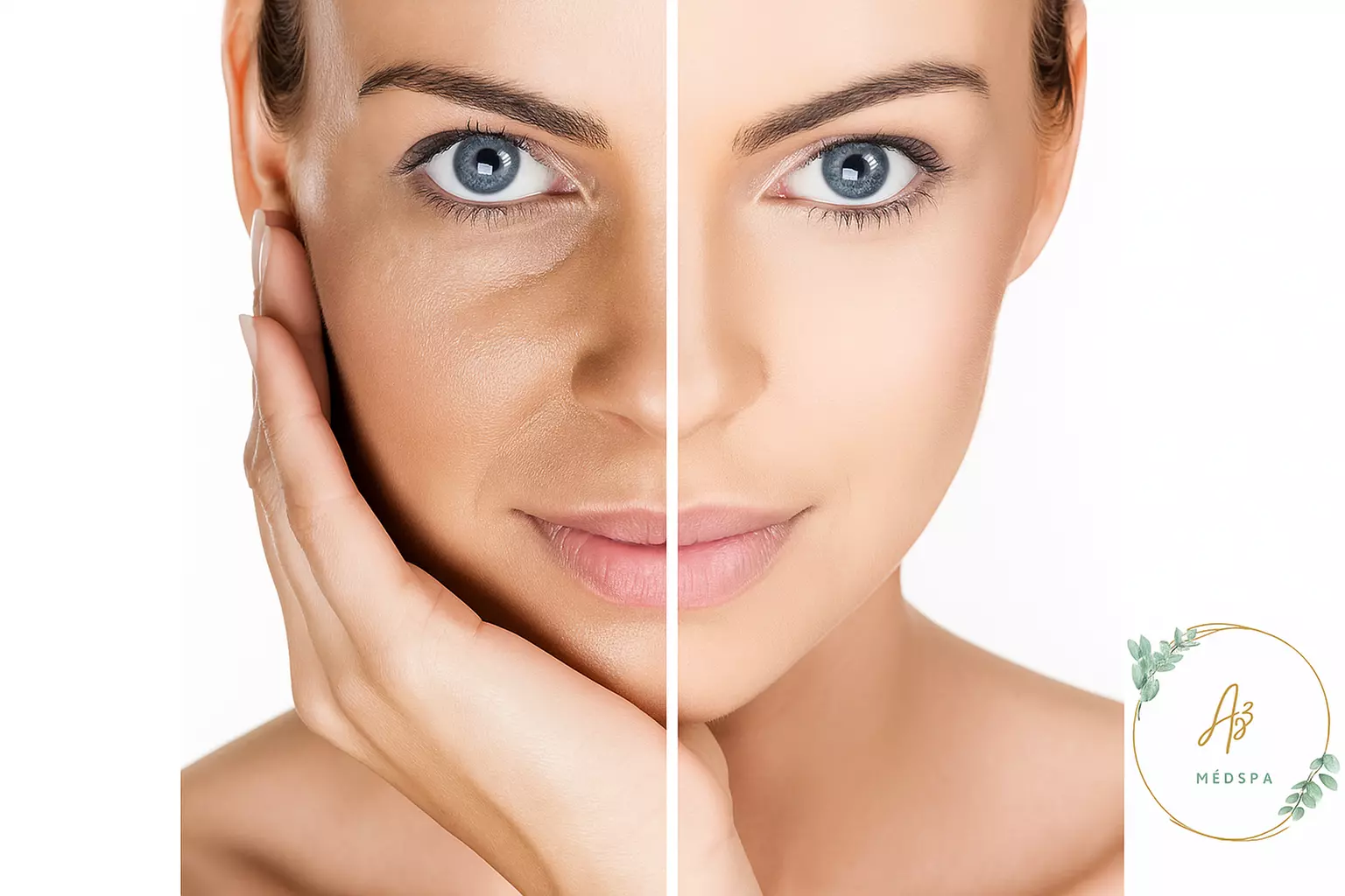  Laser Skin Resurfacing - Branded at AS3 MEDICAL SPA
