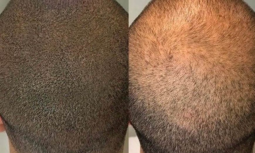 Image 2: Areola Tattoo Treatment, Scalp Micropigmentation Or Cheek Blush Tattoo