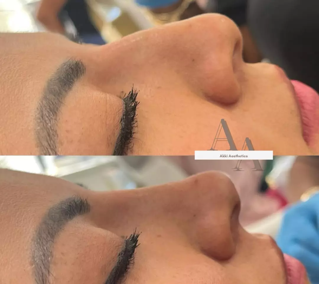 Up to 57% Off on Injection - Dermal Filler at Akki Aesthetics