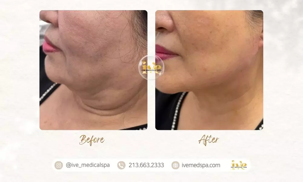 PDO or PCL Thread Lift Session: Jawline, Neck with Optional Nose, Face