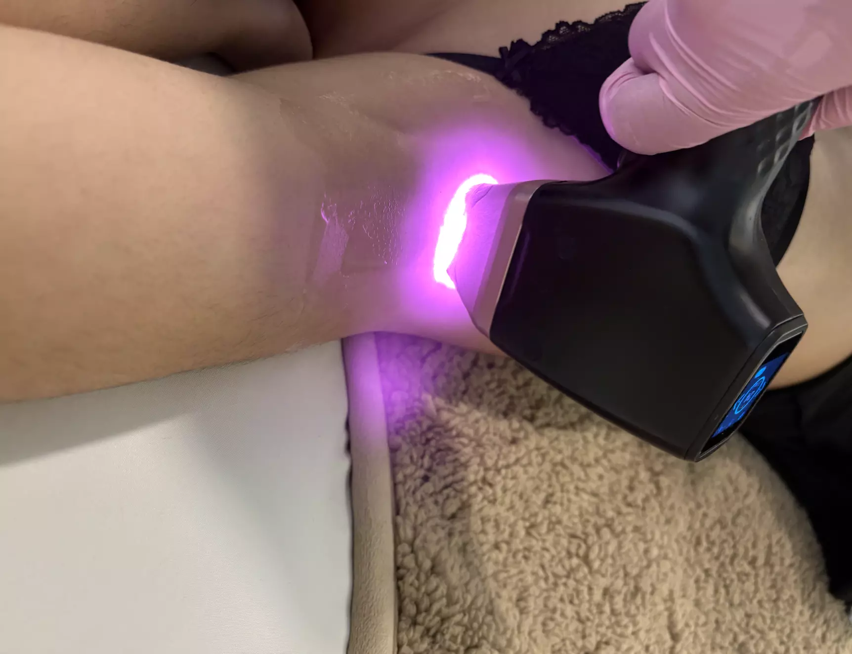 Laser Hair Removal - One Extra Large | Large | Medium | Small Area