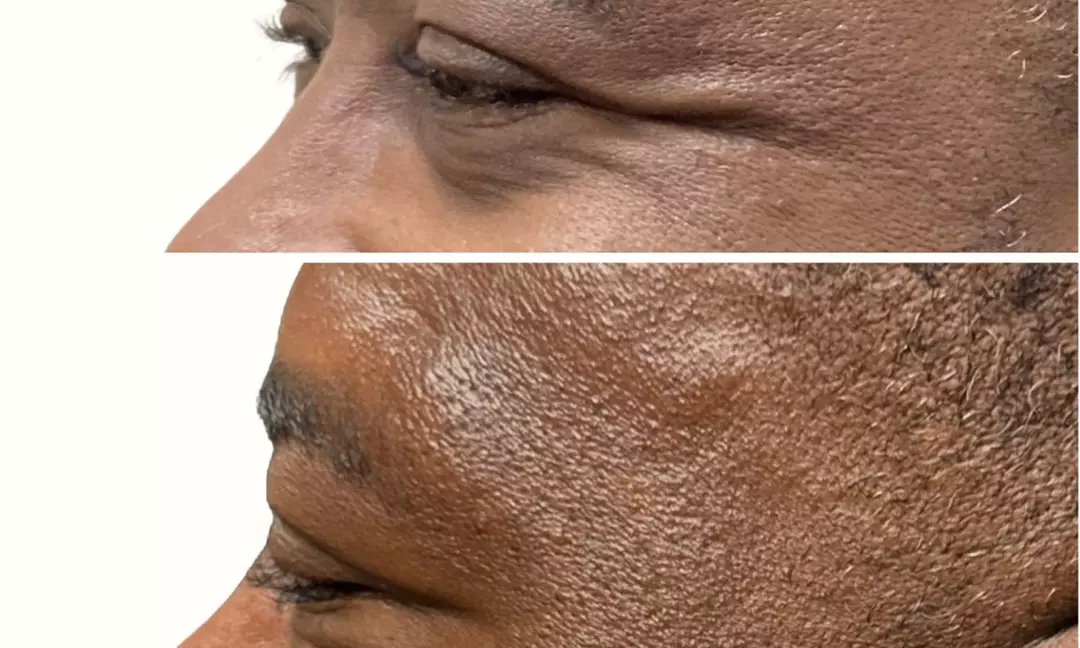 Smooth Your Skin with 20, 40 or 60 Units of Xeomin Injections