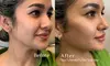 Sculpt Your Jawline with Logica Aesthetics' Juvederm Ultra/Volux XC (Up to 55% Off)